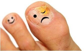 żółta grzybica paznokci