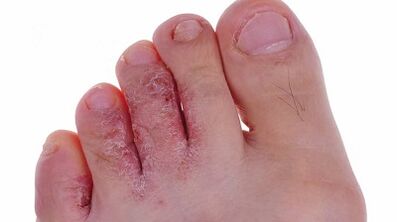 Rodzaje i fazy rozwoju grzybów na nogach