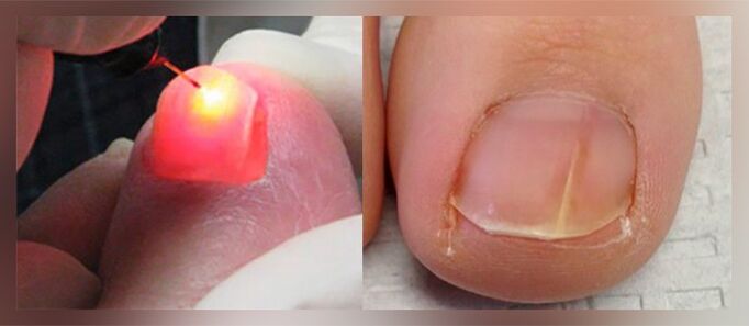Laseroterapia